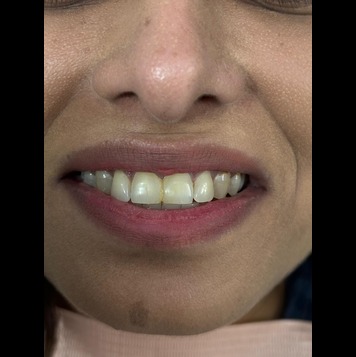 Veneers & Crowns - Before & After